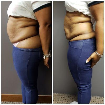 First time Client.... Laser Lipo/ Lipo Cavitation Treatment  Before & After