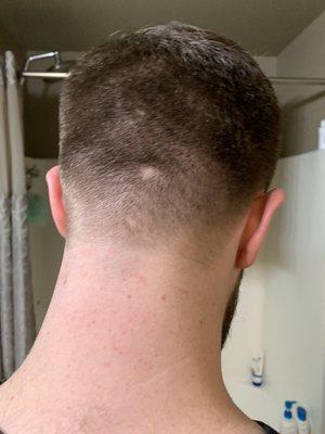 My brother got this bald spot cut into his hair on the back