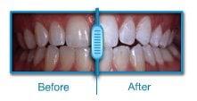 Teeth Whitening