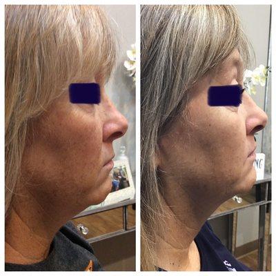 Kybella pre/post photo after three session.