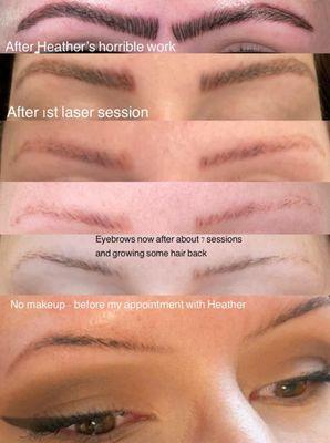 Botch microblading removed by Cat after just 7 sessions of PicoSure