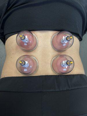 Cupping therapy