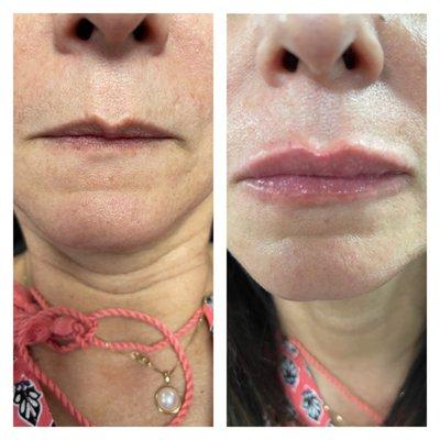 Juvederm lip filler