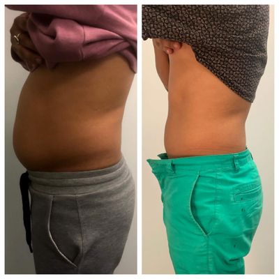 Result after 8 slimming treatments