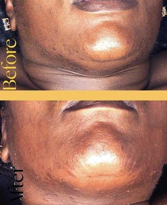 Chin wax before & after