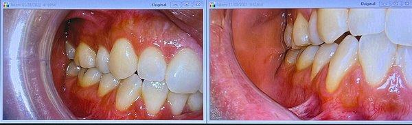 Gum graft surgery before and after pictures.