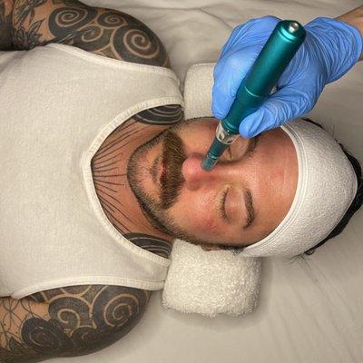 Microneedling