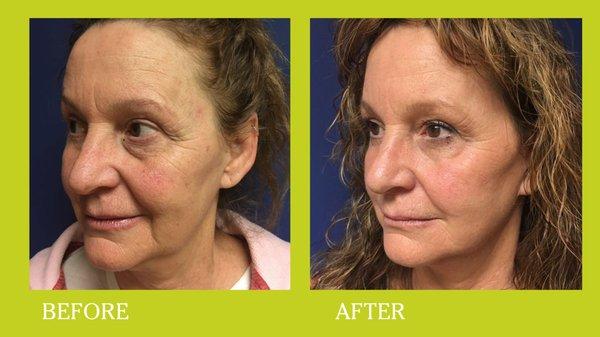 Facelift and Lower Eyelids.