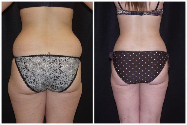 Liposuction Before & After