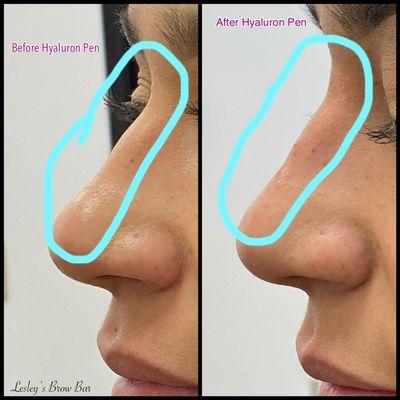 Hyaluron Pen Needle-less Fillers on Nasal Bridge