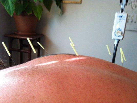 Acupuncture for mid-back pain. Seirin 36 gauge needles.