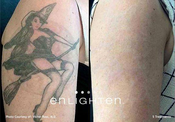 Laser Tattoo Removal NYC - Before & After