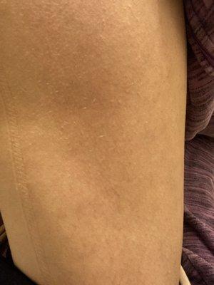 Bed Bug Bites