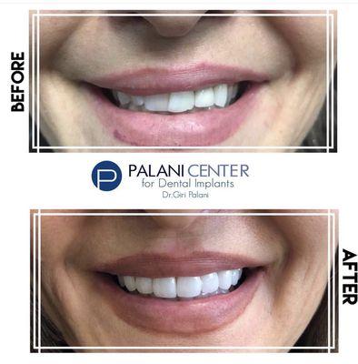 Beautiful, natural Veneers.