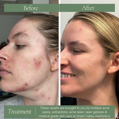 9 month results from Green Valley Aesthetics. Medical grade at home skin care with a healthy lifestyle change can make a big impact at GVA!