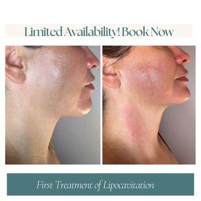 Before & After Face & Neck Tightening