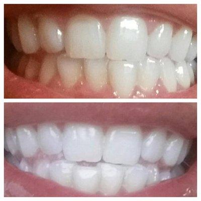 Teeth whitening