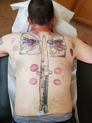 Cupping combined with acupuncture treatment