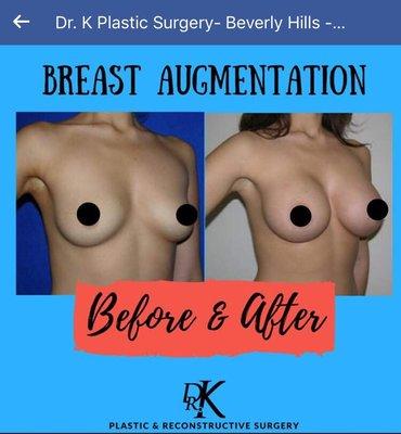 Breast augmentation