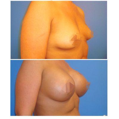 Before & After: Breast Augmentation