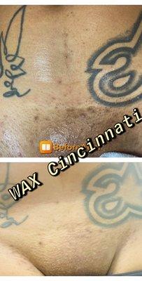 Before & After Vagacial Treatment