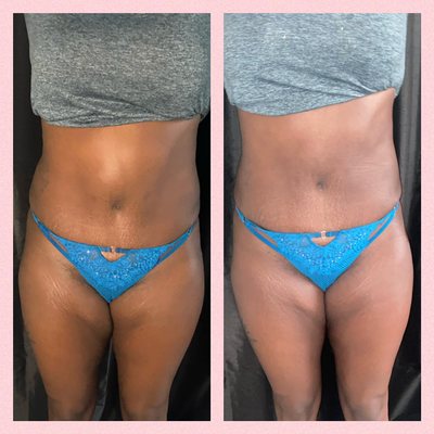 Lipo cavitation session 1