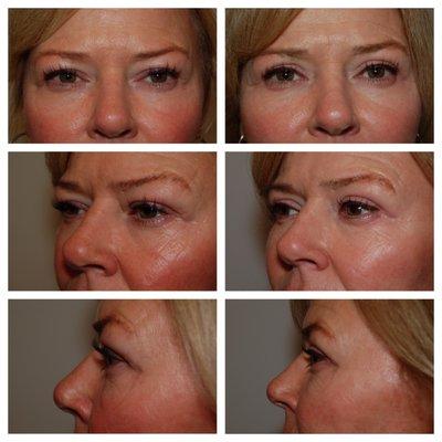 Upper Blepharoplasty