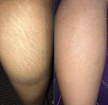 Before and after stretch mark camouflage.