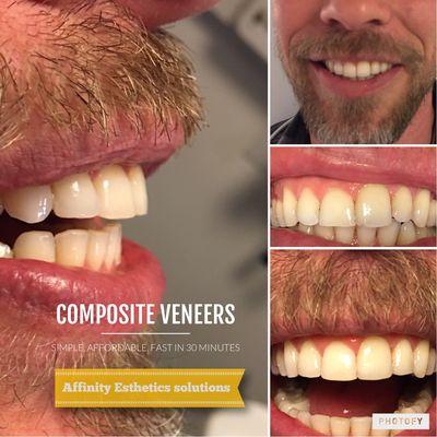 Composite Veneers - affordable cosmetic solution to enhance your smile in less that an hour.