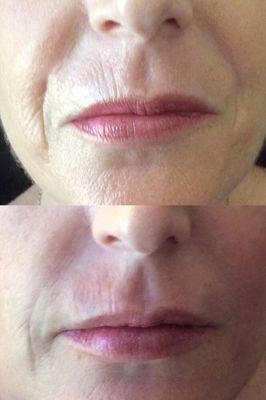 Subtle lip rejuvenation with Volbella