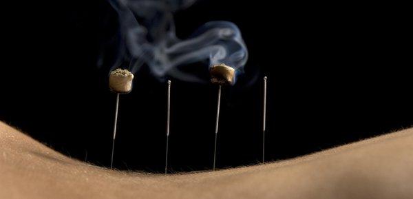 Moxibustion