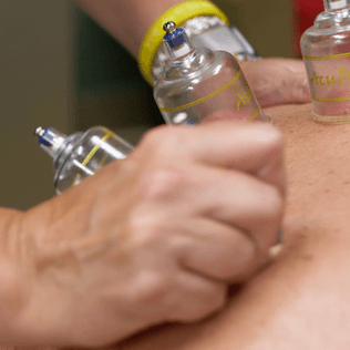 Cupping