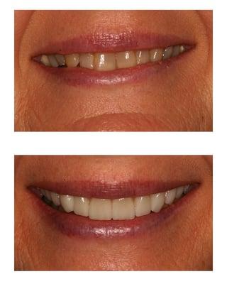 we re-create smiles with porcelain veneers and crowns