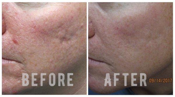 Skin resurfacing to treat acne scarring