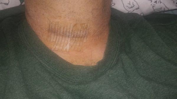 The three and three quarter inch incision on my throat after my surgery that needed care.