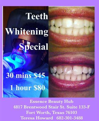 Teeth whitening