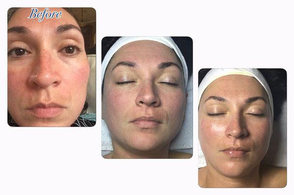 First pic: before treatment, 2nd pic: post microdermabrasion 3rd pic: post microdermabrasion & Vitamin C peel