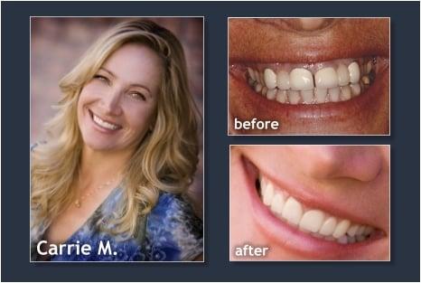 Before and After, Vacaville's Cosmetic Dentist Bruce Bosler DDS