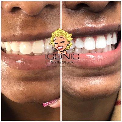 Activate your smile with a 1-Hour Power Teeth Whitening Session at Iconic Smile Studio!