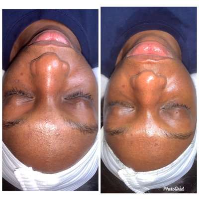 Before and after Vibrant Facial Treatment