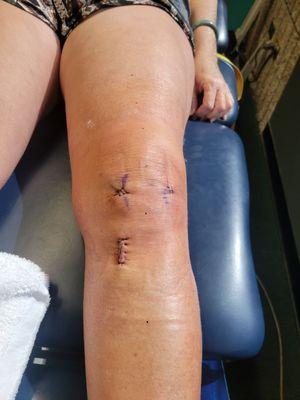 Major Leg surgery