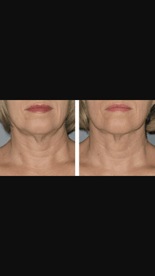 Smoothing and firming the neck non surgically