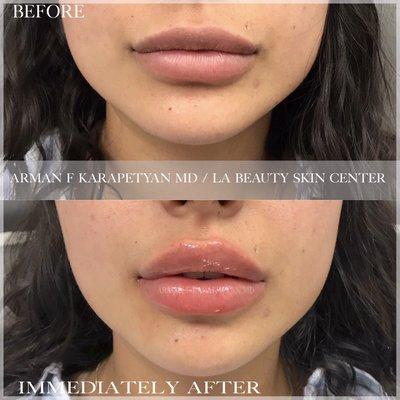 Non-Surgical Lip Augmentation With Juvederm Ultra Plus by Arman F Karapetyan, MD. Gorgeous!