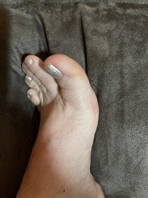 Callous on left foot.