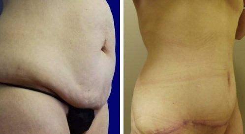 Abdominoplasty (Tummy Tuck)