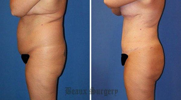 Ultra-High Def Liposuction
 Using VASER 1.0 and special techniques, we can not only flatten, but greatly enhance the definition and presence