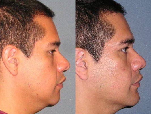 Rhinoplasty