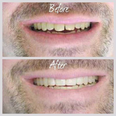 Shape corrected by veneers