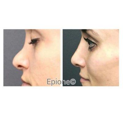 Before and after for Nose augmentation using Dermal Fillers- available at Better U