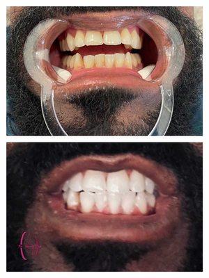 Cosmetic teeth whitening just before the holidays